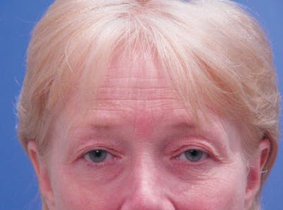 Brow Lift Before & After Gallery - Patient 251897 - Image 1