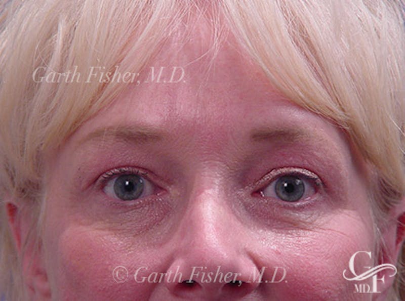 Brow Lift Before & After Gallery - Patient 251897 - Image 2