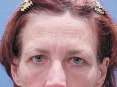 Brow Lift Before & After Gallery - Patient 354605 - Image 1