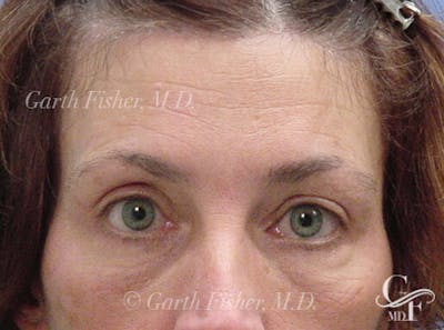 Brow Lift Before & After Gallery - Patient 354605 - Image 2
