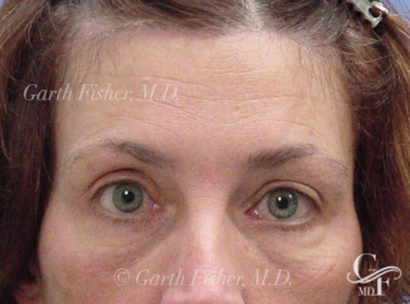 Brow Lift Before & After Gallery - Patient 354605 - Image 2