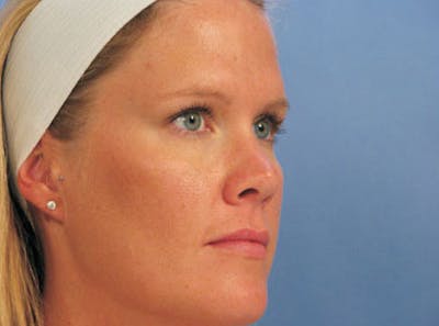 Brow Lift Before & After Gallery - Patient 302961 - Image 1