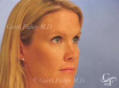 Brow Lift Before & After Gallery - Patient 302961 - Image 2