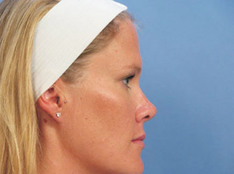 Brow Lift Before & After Gallery - Patient 302961 - Image 3