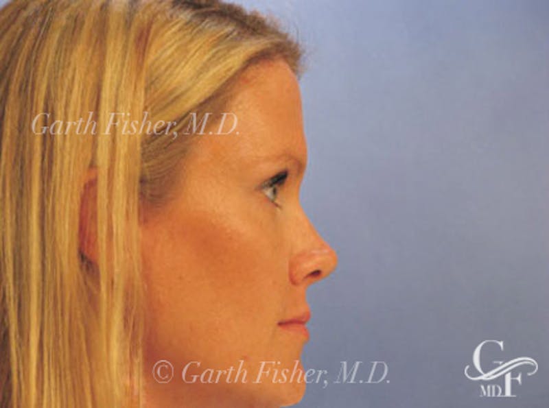 Brow Lift Before & After Gallery - Patient 302961 - Image 4