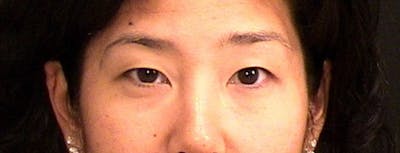 Blepharoplasty Before & After Gallery - Patient 171441 - Image 1