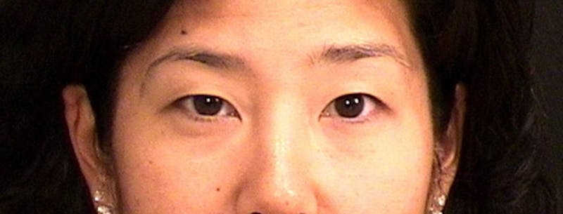 Blepharoplasty Before & After Gallery - Patient 171441 - Image 1