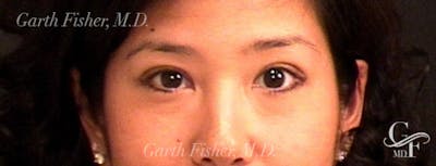 Blepharoplasty Before & After Gallery - Patient 171441 - Image 2