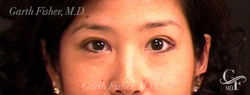 Blepharoplasty Before & After Gallery - Patient 171441 - Image 2