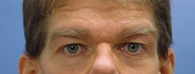 Blepharoplasty Before & After Gallery - Patient 235167 - Image 1