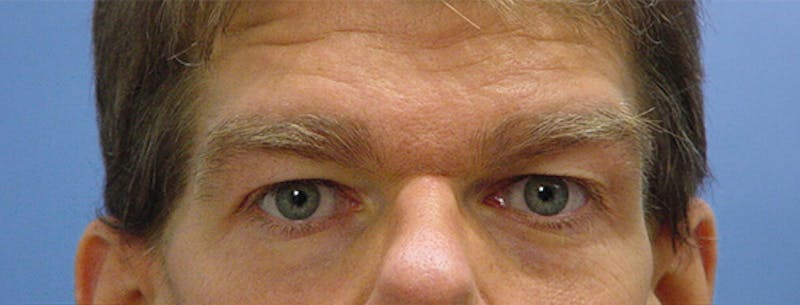 Blepharoplasty Before & After Gallery - Patient 235167 - Image 1