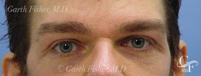 Blepharoplasty Before & After Gallery - Patient 235167 - Image 2