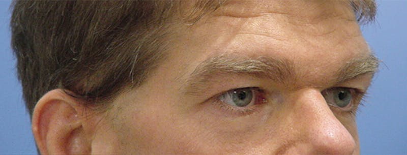 Blepharoplasty Before & After Gallery - Patient 235167 - Image 3