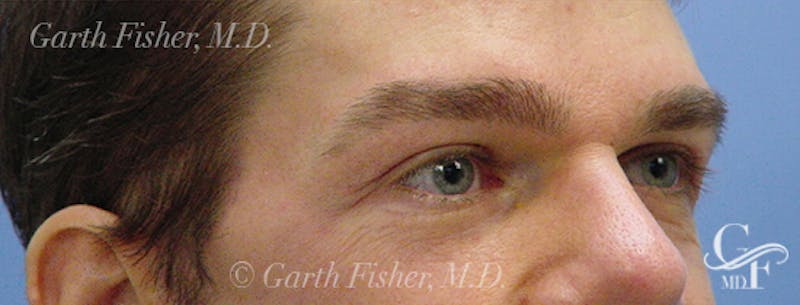 Blepharoplasty Before & After Gallery - Patient 235167 - Image 4