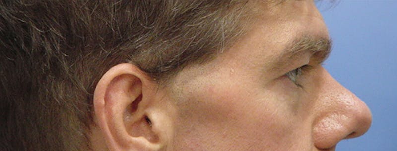 Blepharoplasty Before & After Gallery - Patient 235167 - Image 5