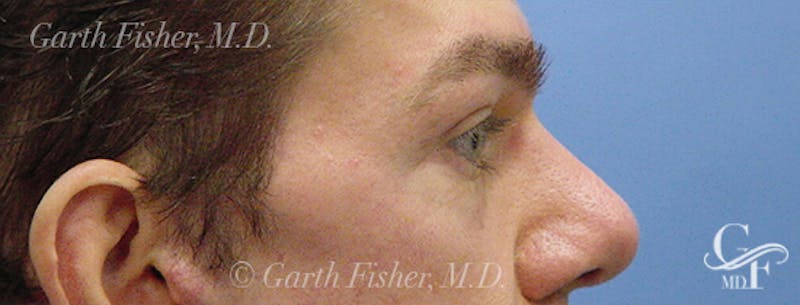 Blepharoplasty Before & After Gallery - Patient 235167 - Image 6
