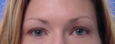 Blepharoplasty Before & After Gallery - Patient 933332 - Image 1