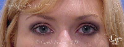 Blepharoplasty Before & After Gallery - Patient 933332 - Image 2