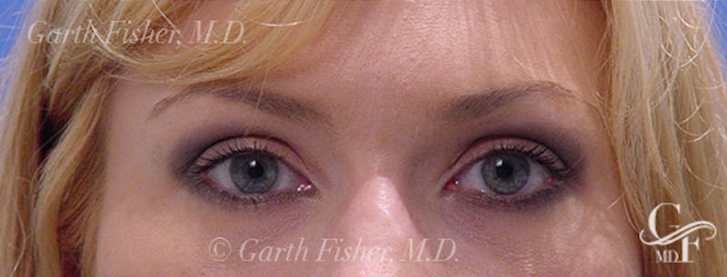 Blepharoplasty Before & After Gallery - Patient 933332 - Image 2