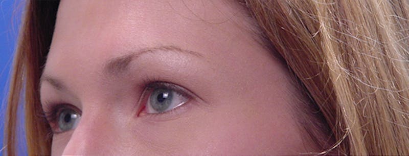 Blepharoplasty Before & After Gallery - Patient 933332 - Image 3
