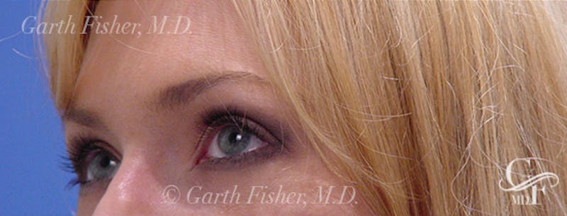 Blepharoplasty Before & After Gallery - Patient 933332 - Image 4