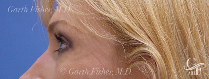 Blepharoplasty Before & After Gallery - Patient 933332 - Image 6