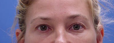 Blepharoplasty Before & After Gallery - Patient 293394 - Image 1