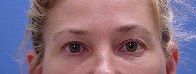 Blepharoplasty Before & After Gallery - Patient 293394 - Image 1