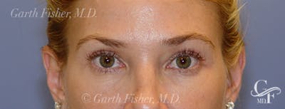 Blepharoplasty Before & After Gallery - Patient 293394 - Image 2