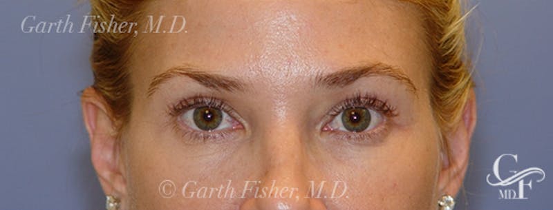 Blepharoplasty Before & After Gallery - Patient 293394 - Image 2