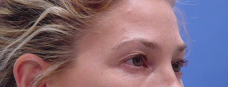 Blepharoplasty Before & After Gallery - Patient 293394 - Image 3