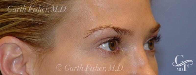 Blepharoplasty Before & After Gallery - Patient 293394 - Image 4