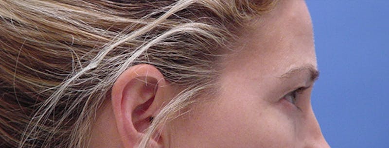 Blepharoplasty Before & After Gallery - Patient 293394 - Image 5