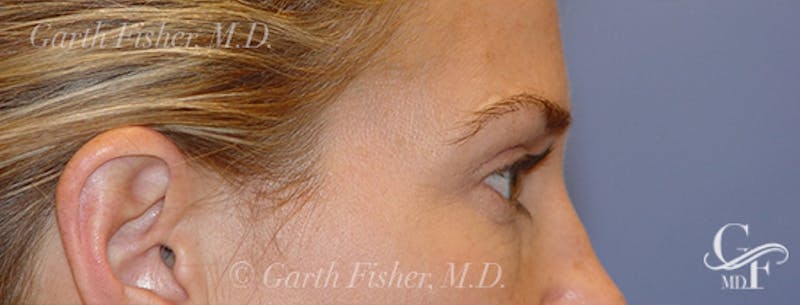 Blepharoplasty Before & After Gallery - Patient 293394 - Image 6