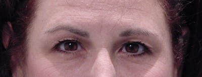 Blepharoplasty Before & After Gallery - Patient 412985 - Image 1