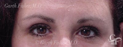 Blepharoplasty Before & After Gallery - Patient 412985 - Image 2
