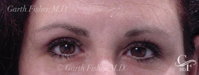 Blepharoplasty Before & After Gallery - Patient 412985 - Image 2