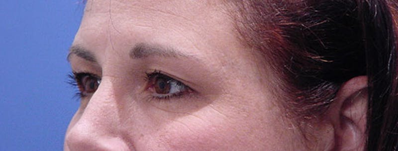 Blepharoplasty Before & After Gallery - Patient 412985 - Image 3