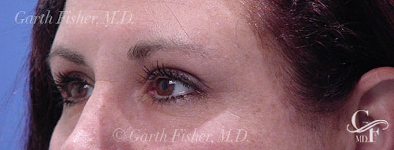 Blepharoplasty Before & After Gallery - Patient 412985 - Image 4