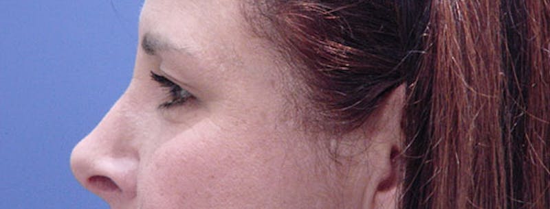 Blepharoplasty Before & After Gallery - Patient 412985 - Image 5