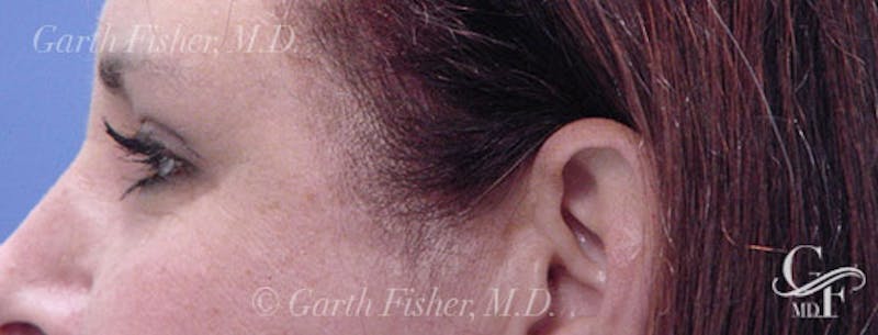 Blepharoplasty Before & After Gallery - Patient 412985 - Image 6