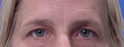 Blepharoplasty Before & After Gallery - Patient 395193 - Image 1