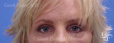 Blepharoplasty Before & After Gallery - Patient 395193 - Image 2