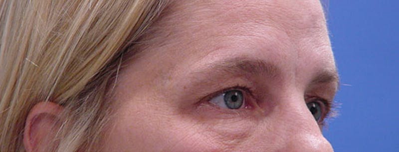 Blepharoplasty Before & After Gallery - Patient 395193 - Image 3