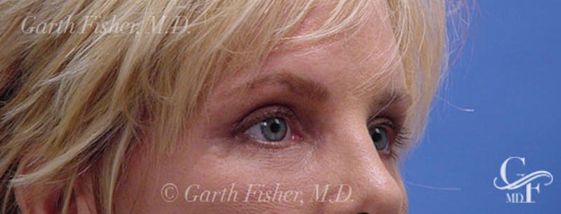 Blepharoplasty Before & After Gallery - Patient 395193 - Image 4