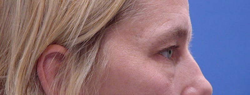 Blepharoplasty Before & After Gallery - Patient 395193 - Image 5