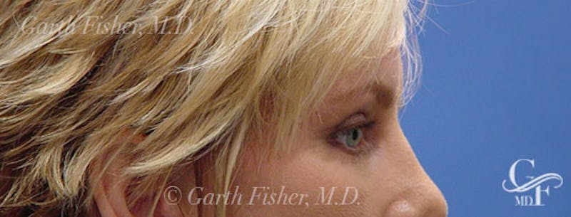 Blepharoplasty Before & After Gallery - Patient 395193 - Image 6