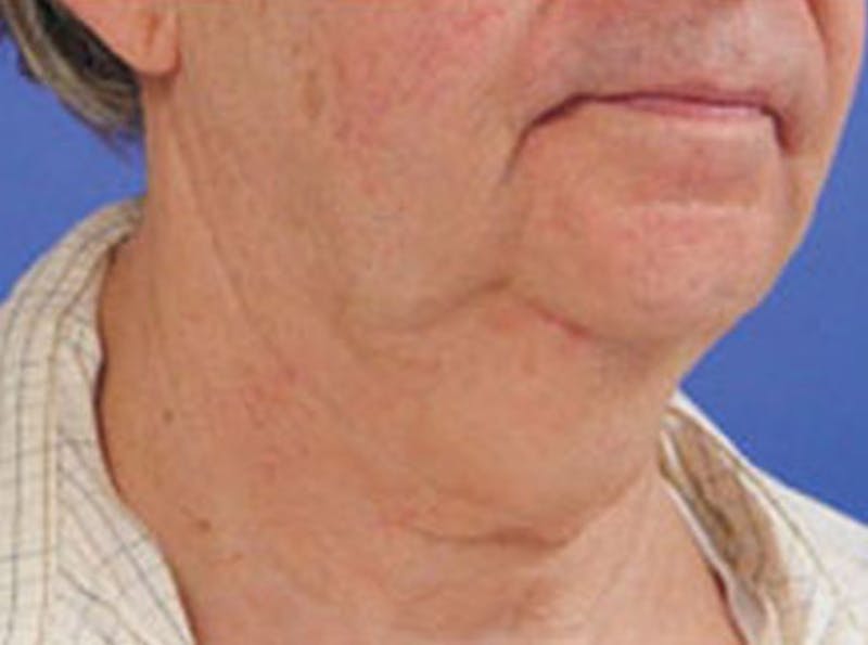 Neck Lift Before & After Gallery - Patient 794169 - Image 1