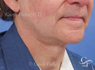 Neck Lift Before & After Gallery - Patient 794169 - Image 2