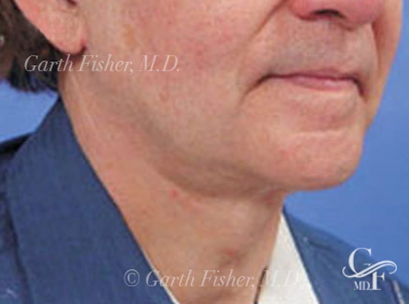 Neck Lift Before & After Gallery - Patient 794169 - Image 2